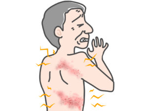 帯状疱疹について